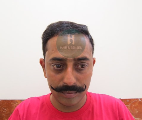 Hair Transplant Case Study